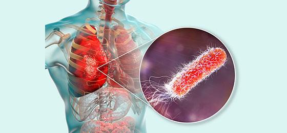 In der Lunge von Patienten mit zystischer Fibrose können Keime zu chronischen Entzündungen führen.